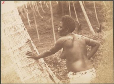 Young women showing her body marking, New Britain Island, Papua New Guinea, probably 1916