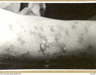 FORBES, AUSTRALIA. 1943-02. ANTERIOR SURFACE OF ELBOW OF A HUMAN "GUINEA PIG" ON THE MORNING OF THE SECOND DAY AFTER IT HAD BEEN EXPOSED TO THE EFFECTS OF GAS FROM GAS SHELLS FIRED IN AN ..