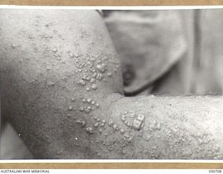 GRAFTON, NSW. 1943-04. BLISTERS SUSTAINED BY ARMY PERSONNEL TAKING PART IN CHEMICAL WARFARE EXPERIMENTS NEAR LAKE HIAWATHA. THE PERSONNEL WERE ACTING AS HUMAN "GUINEA PIGS" AND ENTERED AN AREA THAT ..