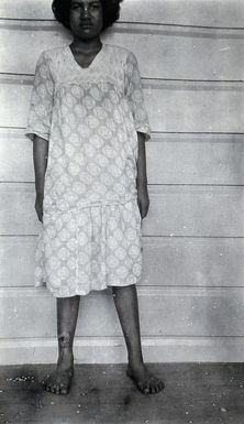 ["Standing woman, full-length front view, with a growth on her lower right leg, Fiji. Photograph, 1920/1921."]