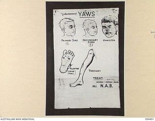 LAE AREA, NEW GUINEA, 1945-08-03. A "PIDGIN" ENGLISH CHART USED FOR THE INSTRUCTION OF NATIVE REGIMENTAL AID POST ORDERLIES. THE PHOTOGRAPH WAS MADE AT THE REQUEST OF HEADQUARTERS AUSTRALIAN NEW ..