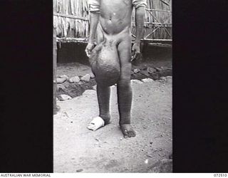 GOODENOUGH ISLAND, 1944-04-21. AT THE AUSTRALIAN NEW GUINEA ADMINISTRATIVE UNIT NATIVE HOSPITAL AT GOODENOUGH ISLAND, AN EXAMPLE OF A NATIVE SUFFERING FROM ELEPHANTIASIS