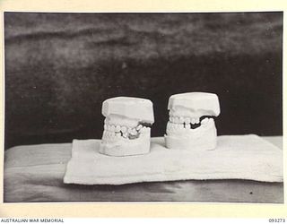TOROKINA, BOUGAINVILLE, 1945-06-21. TREATMENT OF MALOCCLUSION FOR PATIENT, NPL MORRIS, AT HQ 4 BASE SUB AREA, BY DENTAL OFFICER, MAJ A. G. ROWELL. THE MODELS, LEFT LATERAL VIEW. NORMAL VERTICAL ..