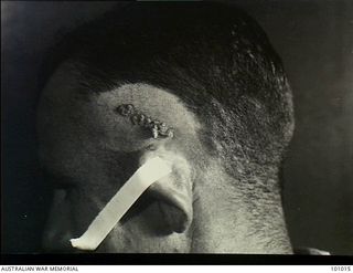Lae, New Guinea. 1945-05-04. Medical record photograph made at the request of Major R. Perkings, Dermatologist, 2/7th Australian General Hospital showing a patient suffering from Naevus Linearis ..