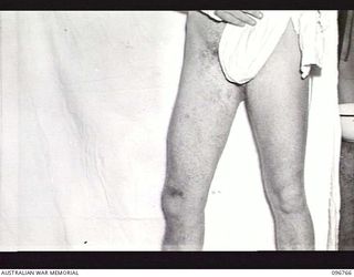 CAPE WOM, NEW GUINEA, 1945-09-17. PRIVATE G. DANIELS, OF 2/1ST AUSTRALIAN INFANTRY BATTALION, SHOWING A BAD INFECTION ON HIS RIGHT LEG