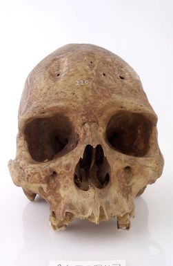 ["A human skull showing signs of Trepanning."]