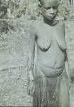 Huge tropical ulcers, Iuri woman, Green River Patrol [Post],[Papua New Guinea], 1954