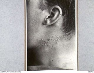 GRAFTON, NSW. 1943-04. BLISTERS SUSTAINED BY ARMY PERSONNEL TAKING PART IN CHEMICAL WARFARE EXPERIMENTS NEAR LAKE HIAWATHA. THE PERSONNEL WERE ACTING AS HUMAN "GUINEA PIGS" AND ENTERED AN AREA THAT ..