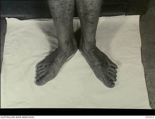 Lae, New Guinea. 1945-05-04. Medical record photograph made at the request of Major R. Perkings, Dermatologist, 2/7th Australian General Hospital showing the legs and feet of a patient suffering ..