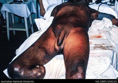 Naked male patient, amputee
