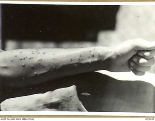 FORBES, AUSTRALIA. 1943-02. LEFT FOREARM OF A "GUINEA PIG" ON THE MORNING OF THE SECOND DAY AFTER IT HAD BEEN EXPOSED TO THE EFFECTS OF GAS WHILE TAKING PART IN AN EXPERIMENTAL SHOOT OF GAS SHELLS. ..