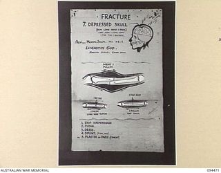 LAE AREA, NEW GUINEA, 1945-08-03. A "PIDGIN" ENGLISH CHART USED FOR THE INSTRUCTION OF NATIVE REGIMENTAL AID POST ORDERLIES. THE PHOTOGRAPH WAS MADE AT THE REQUEST OF HEADQUARTERS AUSTRALIAN NEW ..