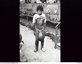 GOODENOUGH ISLAND, PAPUA, 1944-04-22. A NATIVE SUFFERING FROM ELEPHANTIASIS, AT THE AUSTRALIAN NEW GUINEA ADMINISTRATIVE UNIT (ANGAU) HOSPITAL