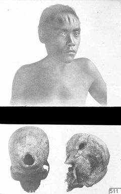Trepanation, photography,