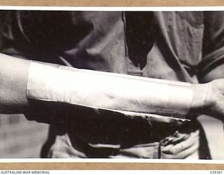 FORBES, AUSTRALIA. 1943-02. A GAUZE PAD BEING PLACED ON THE ARM OF A "GUINEA PIG" WHO, WHILE TAKING PART IN GAS SHELL EXPERIMENTS, INDULGED IN UNAUTHORISED EXPERIMENTS OF HIS OWN. THE INJURY TO THE ..