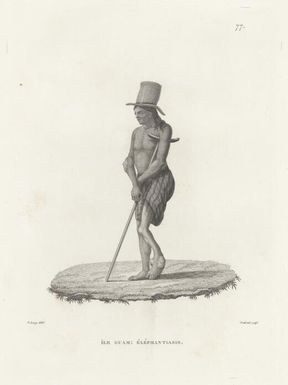 Ile Guam, elephantiasis / Js. Arago delint.; Choubard sculpt