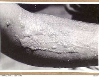 FORBES, AUSTRALIA, 1943-02. THE ARM OF A "GUINEA PIG" TAKING PART IN GAS SHELL EXPERIMENTS WHO INDULGED IN UNAUTHORISED EXPERIMENTS OF HIS OWN. THIS PICTURE SHOWS THE ARM AFTER THE BLISTERS SEEN IN ..