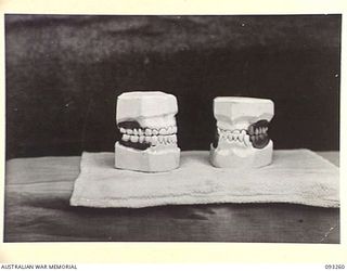 TOROKINA, BOUGAINVILLE, 1945-06-21. TREATMENT OF MALOCCLUSION AT HQ 4 BASE SUB AREA FOR PATIENT SGT A.S. RINGWOOD, BY DENTAL OFFICER, MAJ A.G. ROWELL. MODELS OF DENTURES ANTERIOR VIEW. 'A', NEW PU ..