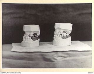 TOROKINA, BOUGAINVILLE, 1945-06-21. TREATMENT OF MALOCCLUSION FOR PATIENT, LT R.C. PRICE, AT HQ 4 BASE SUB AREA, BY DENTAL OFFICER, MAJ A.G. ROWELL. THE MODELS; LEFT LATERAL VIEW. 'A', OLD PU AND ..