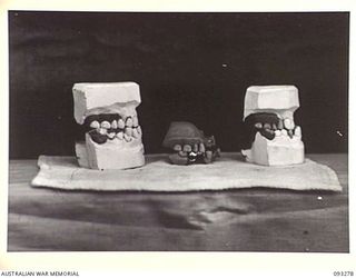 TOROKINA, BOUGAINVILLE, 1945-06-21. TREATMENT OF MALOCCLUSION FOR PATIENT, LT R.C. PRICE, AT HQ 4 BASE SUB AREA, BY DENTAL OFFICER MAJ A.G. ROWELL. MODELS AND DENTURES; RIGHT LATERAL VIEW. 'A', NEW ..