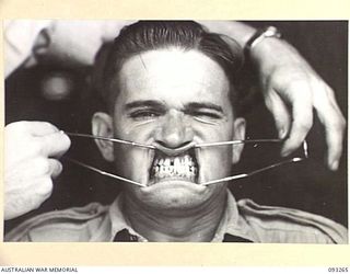 TOROKINA, BOUGAINVILLE, 1945-06-21. TREATMENT OF MALOCCLUSION AT HQ 4 BASE SUB AREA BY DENTAL OFFICER, MAJOR A.G. ROWELL. ANTERIOR VIEW SHOWING PU AND PL DENTURES IN SITU. PATIENT, DRIVER R. ..