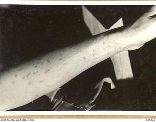 FORBES, AUSTRALIA. 1943-02. LEFT FOREARM OF A "GUINEA PIG" IN THE EVENING OF THE DAY AFTER IT WAS EXPOSED TO THE EFFECTS OF GAS WHILE TAKING PART IN AN EXPERIMENTAL SHOOT OF GAS SHELLS. (SEE ..