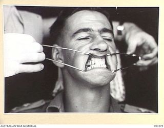 TOROKINA, BOUGAINVILLE, 1945-06-21. TREATMENT OF MALOCCLUSION FOR PATIENT LT R.C. PRICE, AT HQ 4 BASE SUB AREA, BY DENTAL OFFICER, MAJ A.G. ROWELL. ANTERIOR VIEW SHOWING NEW PU AND PL DENTURES IN ..