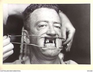 TOROKINA, BOUGAINVILLE, 1945-06-21. TREATMENT OF MALOCCLUSION AT HQ 4 BASE SUB AREA BY DENTAL OFFICER, MAJ A.G. ROWELL. ANTERIOR VIEW SHOWING POSTERIOR TEETH OF PATIENT, SGT W.T. O'CONNOR, IN ..