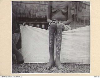 POPONDETTA, NEW GUINEA, 1945-07-02. A CASE OF ADVANCED TERTIARY YAWS AT THE ANGAU NATIVE HOSPITAL. THIS WOMAN WAS LEFT TO DIE BY A VILLAGE ROAD WHEN THE JAPANESE ADVANCED. SHE MANAGED TO BARELY ..