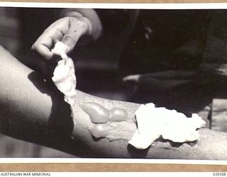 FORBES, AUSTRALIA. 1943-02. SWABBING WITH DETTOL SOLUTION THE ARM OF A "GUINEA PIG" WHO, WHILE TAKING PART IN A GAS SHELL EXPERIMENT, INDULGED IN UNAUTHORISED EXPERIMENTS OF HIS OWN
