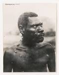 Man with yaws (framboesia) on his face, Gusap, New Guinea, 1945