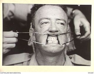 TOROKINA, BOUGAINVILLE, 1945-06-21. TREATMENT OF MALOCCLUSION AT HQ 4 BASE SUB AREA BY DENTAL OFFICER, MAJ A.G. ROWELL; PATIENT, SGT W. T. O'CONNOR. ANTERIOR VIEW OF TEETH WITH NEW PU DENTURE ..