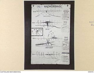 LAE AREA, NEW GUINEA, 1945-08-03. A "PIDGIN" ENGLISH CHART USED FOR THE INSTRUCTION OF NATIVE REGIMENTAL AID POST ORDERLIES. THE PHOTOGRAPH WAS MADE AT THE REQUEST OF HEADQUARTERS AUSTRALIAN NEW ..