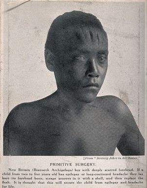 ["A boy with deep scars on his forehead as a result of surgery, in an attempt to cure epilepsy and headaches, Bismarck Archipelago (Papua New Guinea). Halftone."]