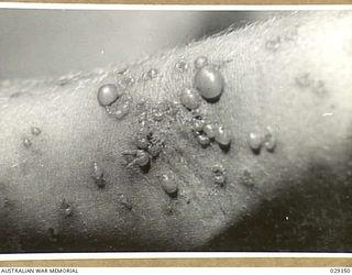 FORBES, AUSTRALIA. 1943-02. ANTERIOR SURFACE OF ELBOW OF A HUMAN "GUINEA PIG" IN THE EVENING OF THE SECOND DAY AFTER IT HAD BEEN EXPOSED TO THE EFFECTS OF GAS FROM GAS SHELLS FIRED IN AN ..