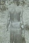 Huge tropical ulcers, Iuri woman, Green River Patrol,[Papua New Guinea], 1954