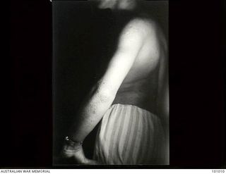 Lae, New Guinea. 1945-05-04. Medical record photograph made at the request of Major R. Perkins, Dermatologist, 2/7th Australian General Hospital showing a patient suffering from Follicular ..