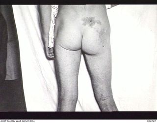 CAPE WOM, NEW GUINEA. PRIVATE G. DANIELS OF 2/1ST AUSTRALIAN INFANTRY BATTALION, SHOWING AN INFECTION ON HIS LOWER BACK