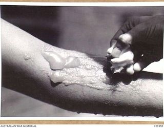 FORBES, NSW. 1943-02. OPENING WITH A STERILE NEEDLE THE BLISTERS ON THE ARM OF A "GUINEA PIG" WHO, WHILE TAKING PART IN AN EXPERIMENTAL GAS SHELL SHOOT, INDULGED IN UNAUTHORISED EXPERIMENTS OF HIS ..