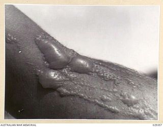 FORBES, AUSTRALIA. 1943-02. LEFT FOREARM OF A "GUINEA PIG" TAKING PART IN AN EXPERIMENTAL GAS SHELL SHOOT, WHO INDULGED IN UNAUTHORISED EXPERIMENTATION OF HIS OWN. THIS IS THE SAME ARM AS SHOWN IN ..