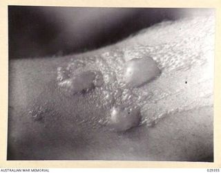 FORBES, AUSTRALIA. 1943-02. LEFT FOREARM OF A "GUINEA PIG" TAKING PART IN AN EXPERIMENTAL GAS SHELL SHOOT, WHO INDULGED IN UNAUTHORISED EXPERIMENTATION OF HIS OWN