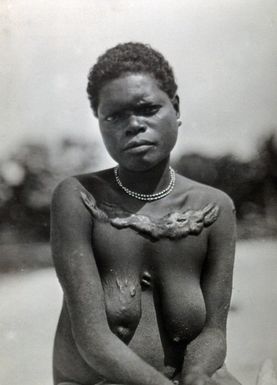 ["Papua New Guinea (?): a woman with a massive scarification over her clavicles"]