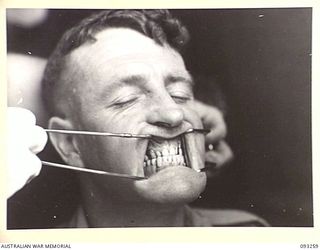 TOROKINA, BOUGAINVILLE, 1945-06-21. TREATMENT OF MALOCCLUSION AT HQ 4 BASE SUB AREA FOR PATIENT SGT A.S. RINGWOOD, BY DENTAL OFFICER, MAJ A.G. ROWELL. ANTERIOR VIEW OF NEW PU AND PL DENTURES IN ..