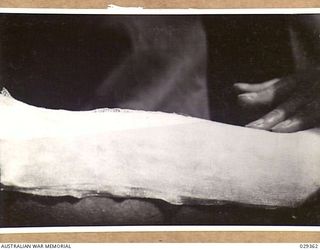 FORBES, AUSTRALIA. 1943-02. OILED SILK IS PLACED OVER THE GAUZE PAD DRESSING ON THE ARM OF A "GUINEA PIG" WHO, WHILE TAKING PART IN GAS SHELL EXPERIMENTS, INDULGED IN UNAUTHORISED EXPERIMENTS OF ..