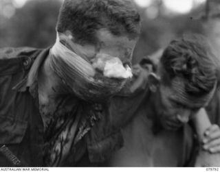 BUT AREA, NEW GUINEA. 1945-03-17. NX32941 PRIVATE J.J. PARKES, NO.10 PLATOON, B COMPANY, 2/2ND INFANTRY BATTALION (2), WHO HAD WALKED 5 MILES AFTER BEING SHOT THROUGH THE FACE, IS ASSISTED BY ..