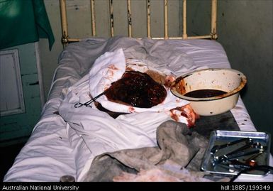 Surgical tools and bowls filled with blood on an unoccupied bed