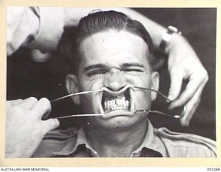 TOROKINA, BOUGAINVILLE, 1945-06-21. TREATMENT OF MALOCCLUSION AT HQ 4 BASE SUB AREA BY DENTAL OFFICER, MAJ A.G. ROWELL. ANTERIOR VIEW; NO DENTURES ARE WORN. NOTE OVERBITE OF LOWER ANTERIOR TEETH ..