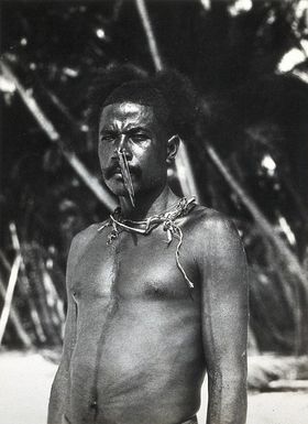 ["Papua New Guinea (?): a man with a large pin through a hole in his nose. Photograph by E.W. Pearson Chinnery (?)."]