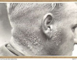 GRAFTON, NSW. 1943-04. BLISTERS SUSTAINED BY ARMY PERSONNEL TAKING PART IN CHEMICAL WARFARE EXPERIMENTS NEAR LAKE HIAWATHA. THE PERSONNEL WERE ACTING AS HUMAN "GUINEA PIGS" AND ENTERED AN AREA THAT ..