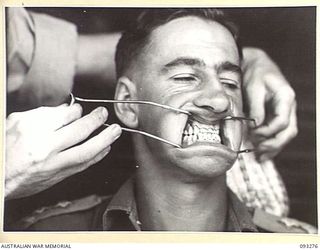 TOROKINA, BOUGAINVILLE, 1945-06-21. TREATMENT OF MALOCCLUSION FOR PATIENT, LT R.C. PRICE, AT HQ 4 BASE SUB AREA, BY DENTAL OFFICER, MAJ A.G. ROWELL. ANTERIOR VIEW SHOWING OLD PU AND PL DENTURES IN ..